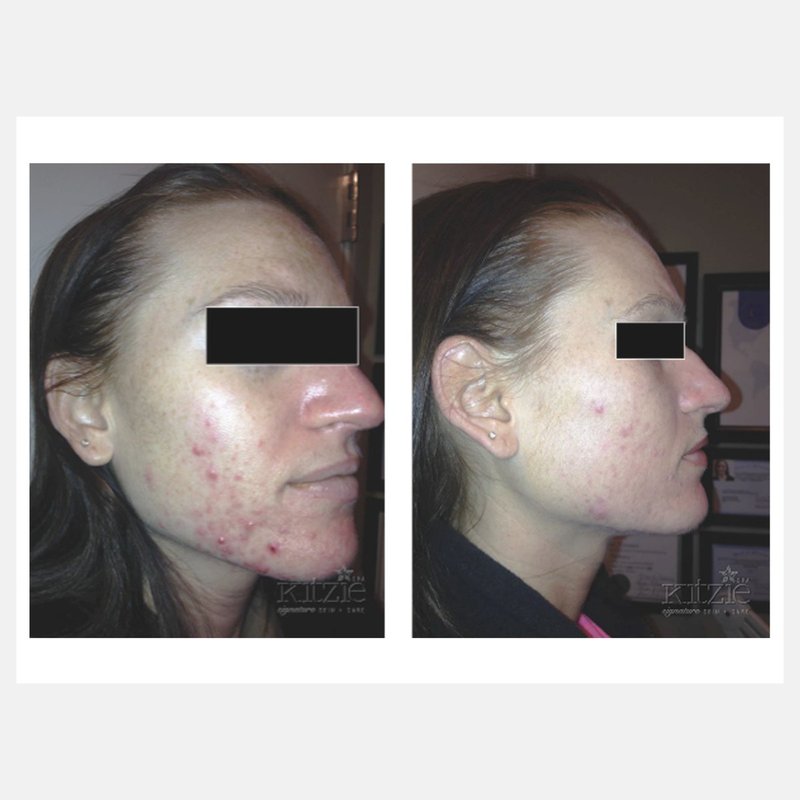 Celluma before and after