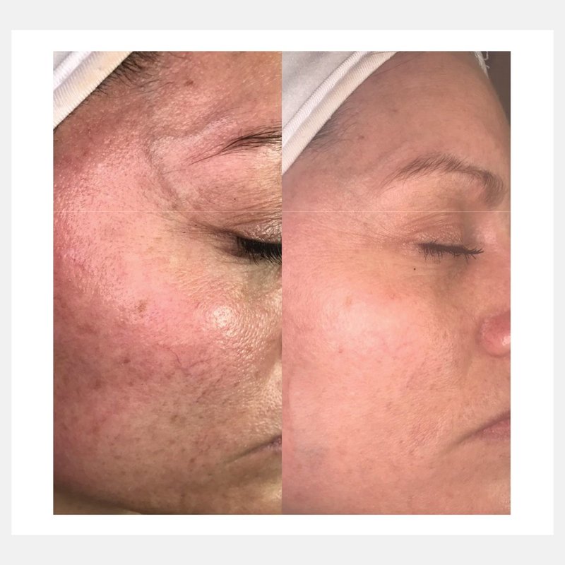 Celluma before and after