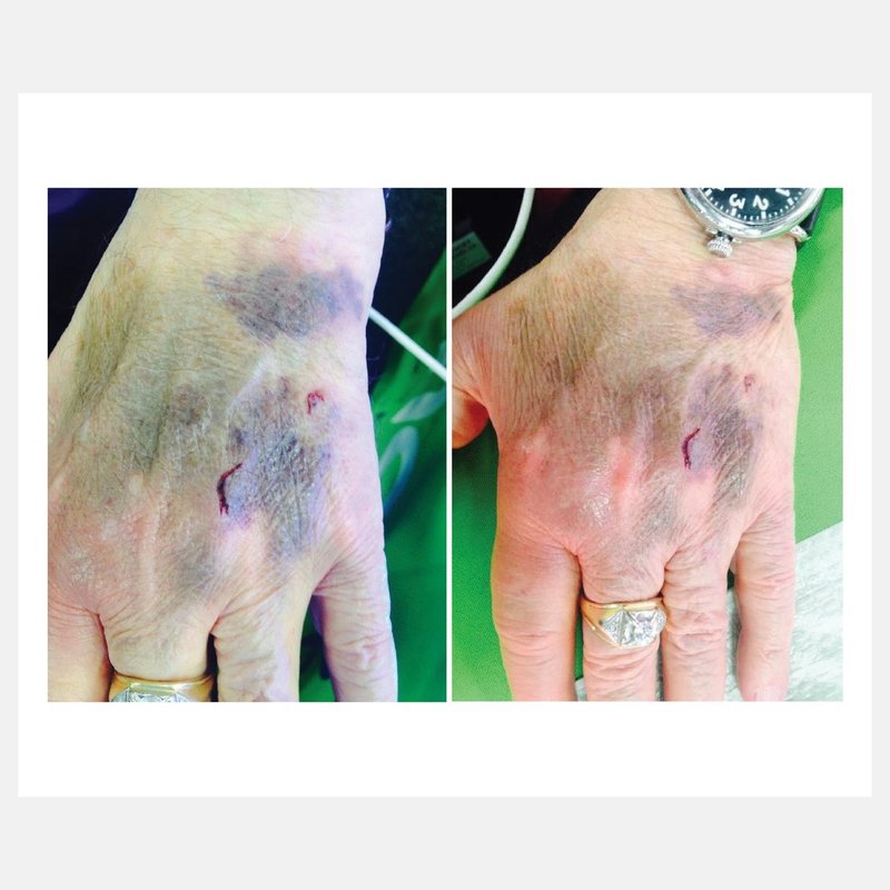 Celluma before and after